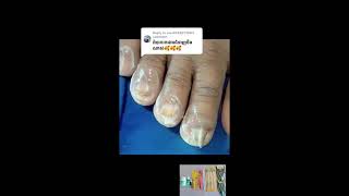 Simple narrow toenail cutting nail​​​ asmr fyp ear shorts viral wax [upl. by Einttirb662]