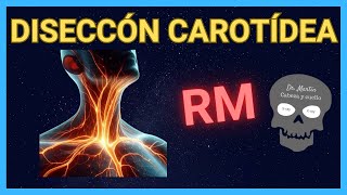 DISECCIÓN CAROTÍDEA 👉en RESONANCIA Magnética [upl. by Keldah511]