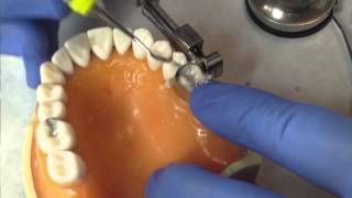 Class II Amalgam Restoration Instructions by Dr Ywom [upl. by Alard]