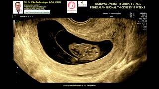 Hygroma Kistik  Hydrops Fetalis  NT Tebal 11 weeks [upl. by Mishaan]