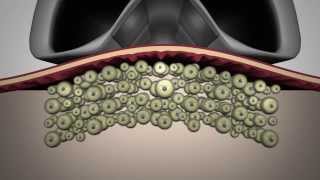 LipoContrast  One step beyond cryolysis [upl. by Josepha185]