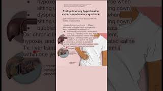 Portopulmonary hypertension vs Hepatopulmonary syndrome [upl. by Eselahc533]