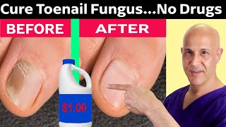 How to Cure Toenail Fungus for Pennies a Day Dr Mandell [upl. by Imoyaba]