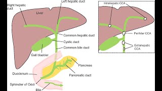 Treatment Options Based on the Extent of Bile Duct Cancer [upl. by Teyugn]