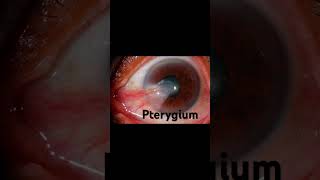 Pterygium  learn and revise a very potential mcq ytshorts ytindia yt eyes [upl. by Hadihsar]