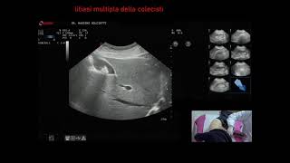 litiasi multipla della colecisti gallstones [upl. by Primrose]