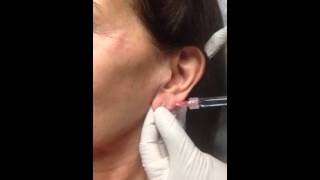 Dr Jegasothy Fixes Sagging Earlobes [upl. by Ajax]