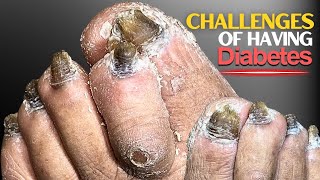 Challenges of Having Diabetes [upl. by Anairuy]