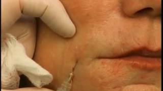 How to Lift Mouth Corners amp Marionettes With A Dermal Filler [upl. by Imik]