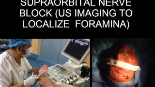 ULTRASOUND GUIDED SUPRAORBITAL NERVE BLOCK ULTRASOUND IMAGING TO LOCALIZE FORAMINA [upl. by Alegna446]