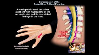 Compression of the Spinal Cord amp Hand Function  Everything You Need To Know  Dr Nabil Ebraheim [upl. by Irep22]