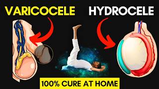 Cure Varicocele amp Hydrocele at home with Yoga varicocele hydrocele cure yoga [upl. by Ku]