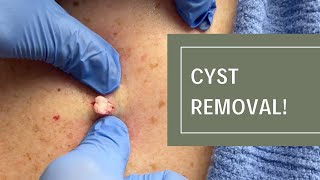 Cyst Removal  Dr Derm [upl. by Frankie]