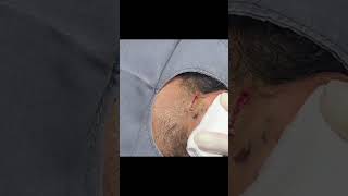 An Ear Cyst You Dont Want to Miss [upl. by Aaronson]