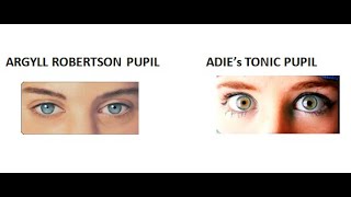 Ophthalmology 326 Argyll robertson pupil Adies tonic pupil neurosyphilis difference pilocarpine test [upl. by Sarena]