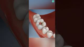 Teeth cavities lactic acid bacteria🤯  teeth painshorts teeth facts [upl. by Aroda]