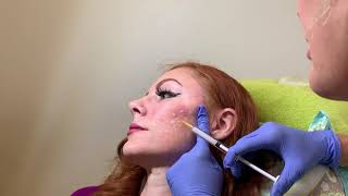 Acne Scar Treatment with Bellafill dermal filler in Seattle at Well Medical Arts [upl. by Akinehc657]