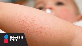 ¿Qué causa la dermatitis atópica  Bien y Saludable [upl. by Fezoj]