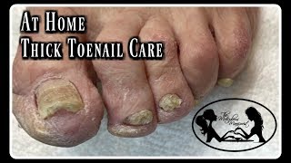 Pedicure At Home Elderly Toenails Cutting Thick Toenails and Nail Fungus [upl. by Dranyar]