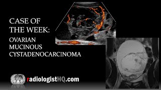 Case of the Week Ovarian Mucinous Cystadenocarcinoma Ultrasound amp MRI [upl. by Nady360]