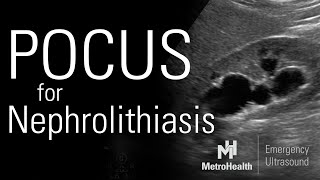 POCUS for Nephrolithiasis [upl. by Caundra]