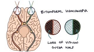 Understanding Bitemporal Hemianopia [upl. by Freddy]