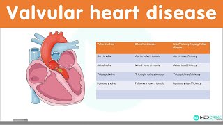 Valvular Heart Diseases Classification Causes Pathophysiology Diagnosis and Treatment [upl. by Anitsrihc]