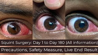 My Story  Before and After SquintStrabismus Surgery Day 1 to Day 180 [upl. by Ellenohs716]