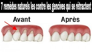 Les 7 remèdes naturels les plus efficaces contre les gencives qui se rétractent [upl. by Vigor]