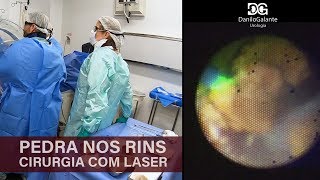 Pedras nos rins  Cirurgia a laser [upl. by Epillihp]