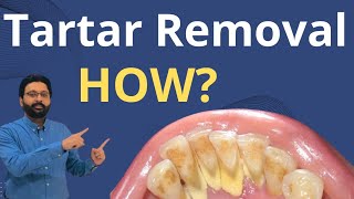 Tartar Removal from Teeth  Dental Teeth Cleaning [upl. by Nospmoht]