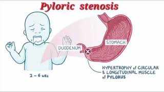 Pyloric stenosis mrcpch Video station [upl. by Naloj]