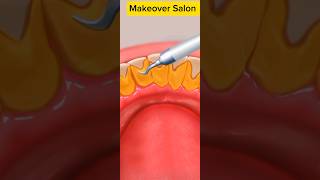 Asmr Tartar Removal Animation [upl. by Suoirtemed]