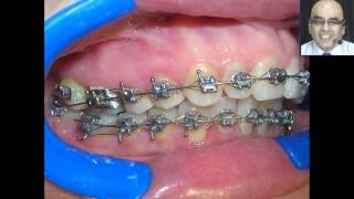 Pegado de Brackets y Tubos en las Tecnicas Individualizadas 2 [upl. by Ylelhsa]