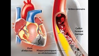 Ischémie infarctus et choc [upl. by Enillebyam]