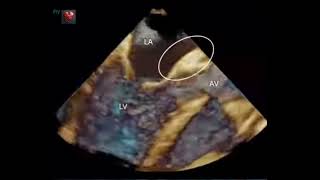 Aneurysm of intervalvular fibrosa [upl. by Hayyim]