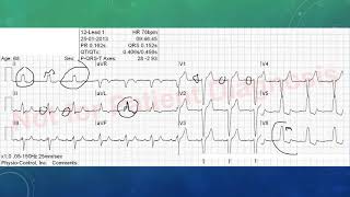 EKG befunden leicht gemacht EKG Beispiele [upl. by Asaret]