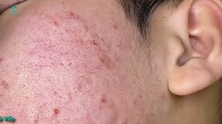 Big Cystic Acne Blackheads Extraction Blackheads amp Milia Whiteheads Removal Pimple Popping 006 [upl. by Aknahs320]