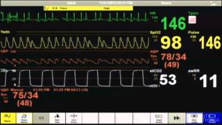 Cardiac Arrest  Patient Monitor [upl. by Idyh926]