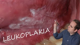 Leukoplakia Common Oral Pathology [upl. by Sorips656]