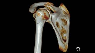 Humerus Greater Tuberosity Fracture [upl. by Fine]