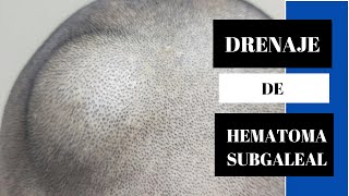 Drenaje de Hematoma Subgaleal [upl. by Ilujna]