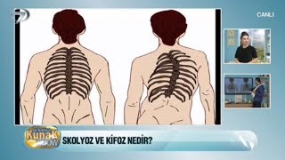 Skolyoz Ve Kifoz Omurga Eğriliği Nedir [upl. by Nereil]