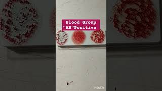 AB Positive blood group kaisa hota hai  AB positive blood group Ab position blood group test [upl. by Latvina]