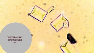 Triple Phosphate Crystals under microscope at 40X [upl. by Coulombe370]