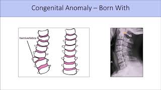 Congenital Spinal Defects  12 of Population Have These [upl. by Prunella]