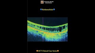 Retinoschisis [upl. by Renie]