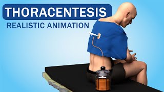 Pleural Tap Explained Lung Fluid Drainage for Relief Thoracentesis [upl. by Dannye91]