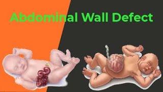 Abdominal Wall Defect with Animation by Ashish Kumar Nursingvideo [upl. by Ylecic]