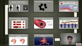 NRSG265 A1 Aortic Aneurysm pathophysiology S00388310 [upl. by Ailis]